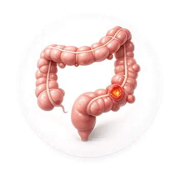Ilustración médica de divertículos del colon