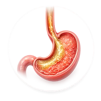 Ilustración médica de hernia hiatal