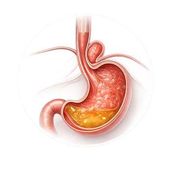 Ilustración médica de reflujo gastroesofágico