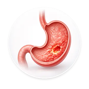 Ilustración médica de úlcera gástrica